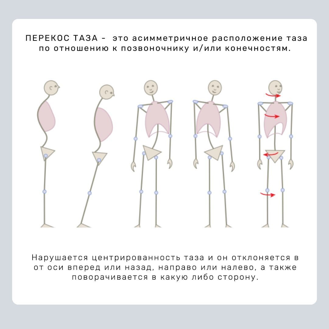 Перекосы и наклоны таза: почему и что делать? | Александра Кибзий | Дзен