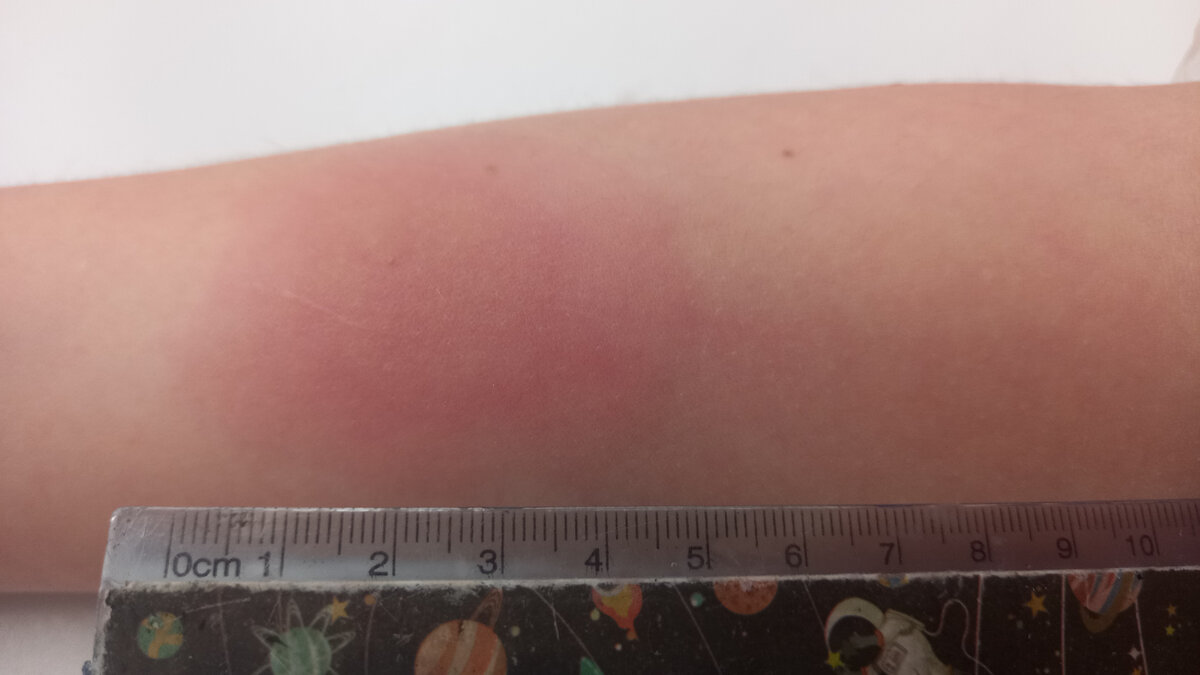 Еле-еле видно папулу, она около 20 мм, и остальное ореол красноты.