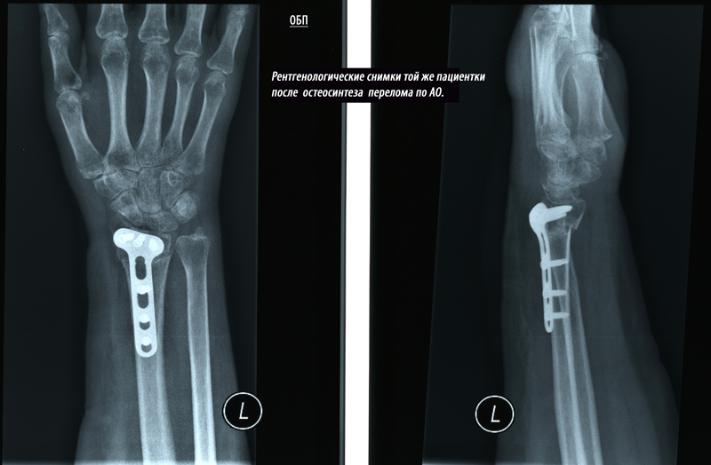 Остеосинтез перелома лучевой кости. Остеосинтез дистального метаэпифиза лучевой кости. Перелом лучевой кости в типичном месте рентген. Остеосинтез ДМЭ лучевой кости.