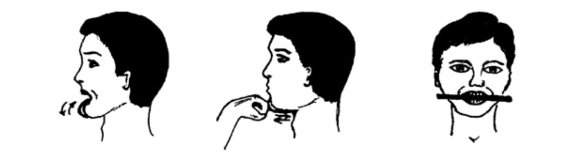 Как расширить челюсть упражнениями. Упражнения для расслабления жевательных мышц челюсти. Упражнения для расслабления челюсти. Миогимнастика при открытом прикусе упражнения. Как расширить челюсть упражнениями.