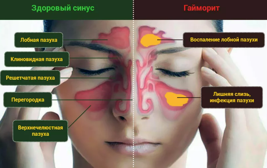 Как болит гайморит симптомы. Воспаление лобной пазухи. Гайморит при беременности.