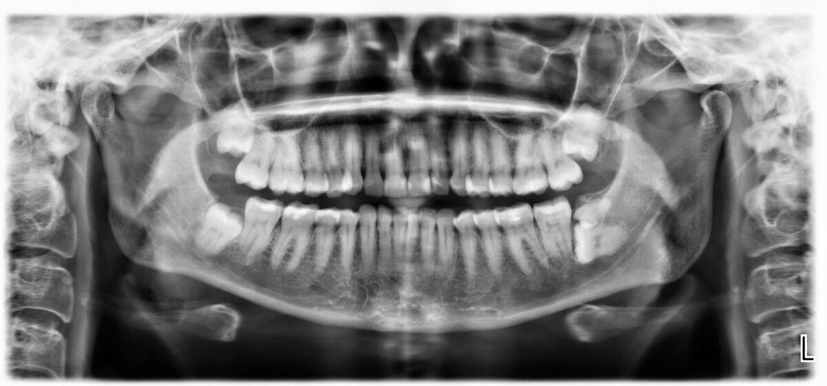 Справа снизу на диагностическом снимке ОПТГ  видим сверхкомплектный 9й зуб