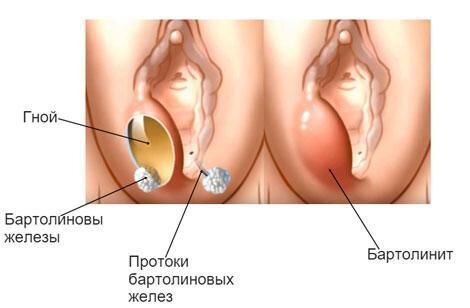 Как растянуть девственную плеву