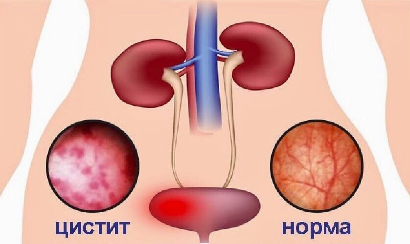 При воспалении мочевого пузыря поражается его слизистый слой
