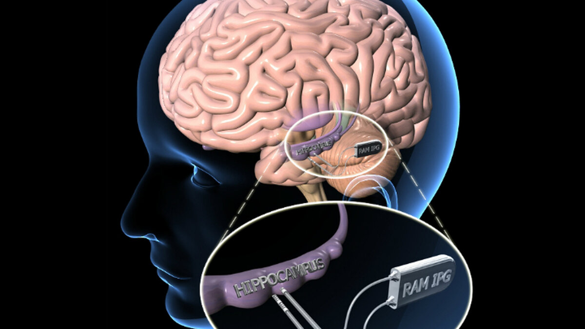 Память функция мозга. Имплантация чипа в мозг.