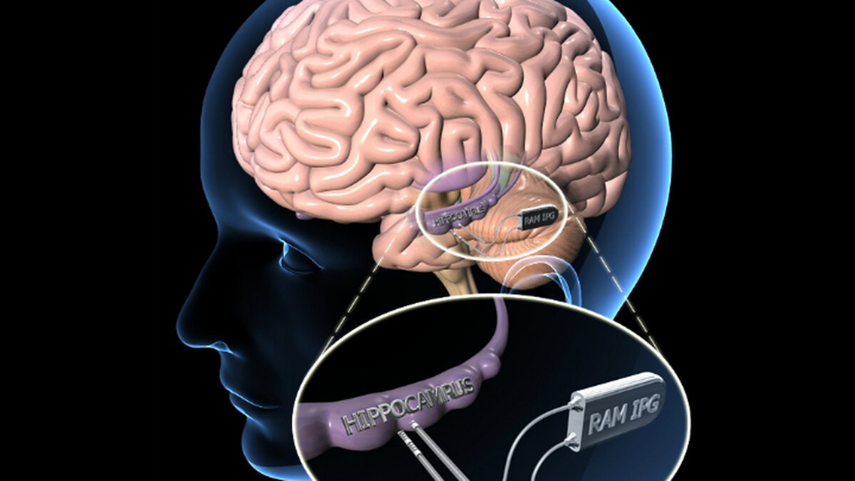 Головные потери памяти. Имплантация чипа в мозг.