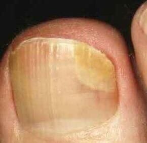 Грибок ногтей