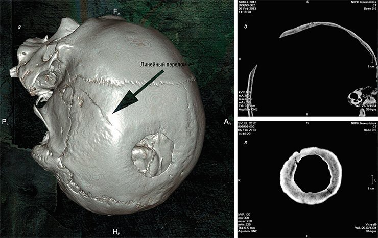 Результаты обследования черепа мужчины из кургана 3 курганной группы Кызыл-Джар–V методом МСКТ: а – объемная модель черепа; б – срез через трепанационный дефект в боковой проекции; в – горизонтальный срез через поверхность трепанационного дефекта. Череп хранится в Томском государственном университете