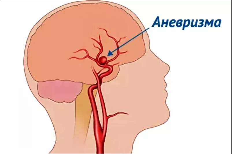 Аневризма сосудов головного мозга. Аневризма артерии головного мозга. Разрыв аневризма головного мозга. Аневризма церебрального сосуда.