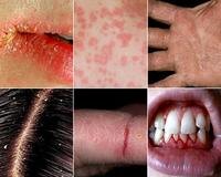 Авитаминоз (гиповитаминоз) – дефицит в организме человека одного витамина или группы витаминов. 