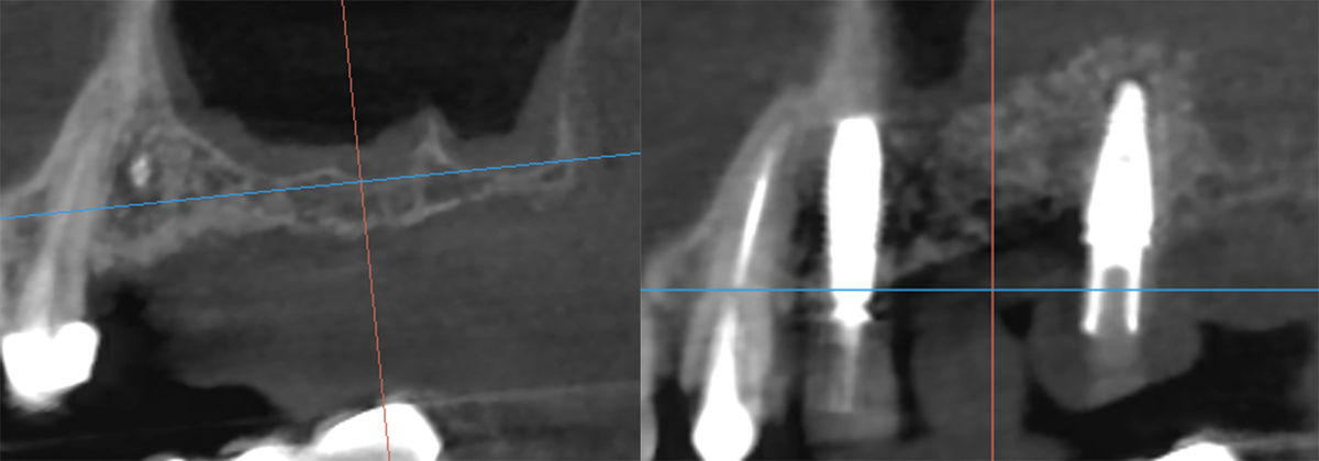 До синус-лифтинга(слева) и после (справа)