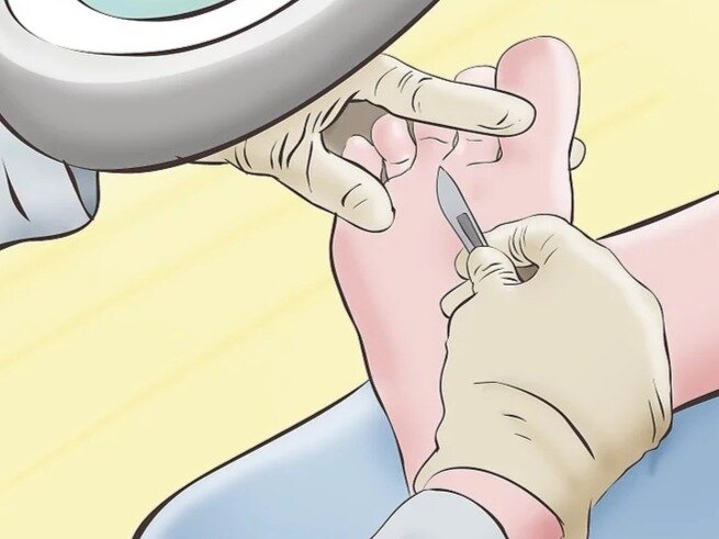 Удаление бородавок - это самый эффективный метод избавления от них.