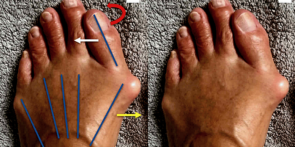 Убрать такую "косточку" возможно только хирургическим путем.