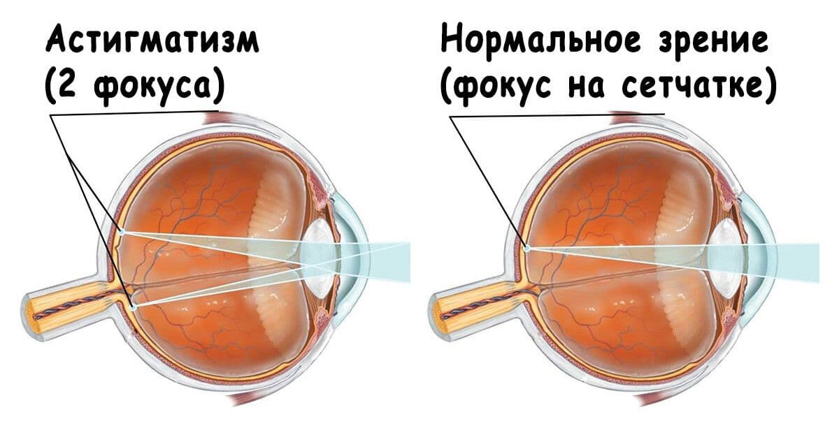 Как фокусируется изображение рассматриваемого предмета при астигматизме