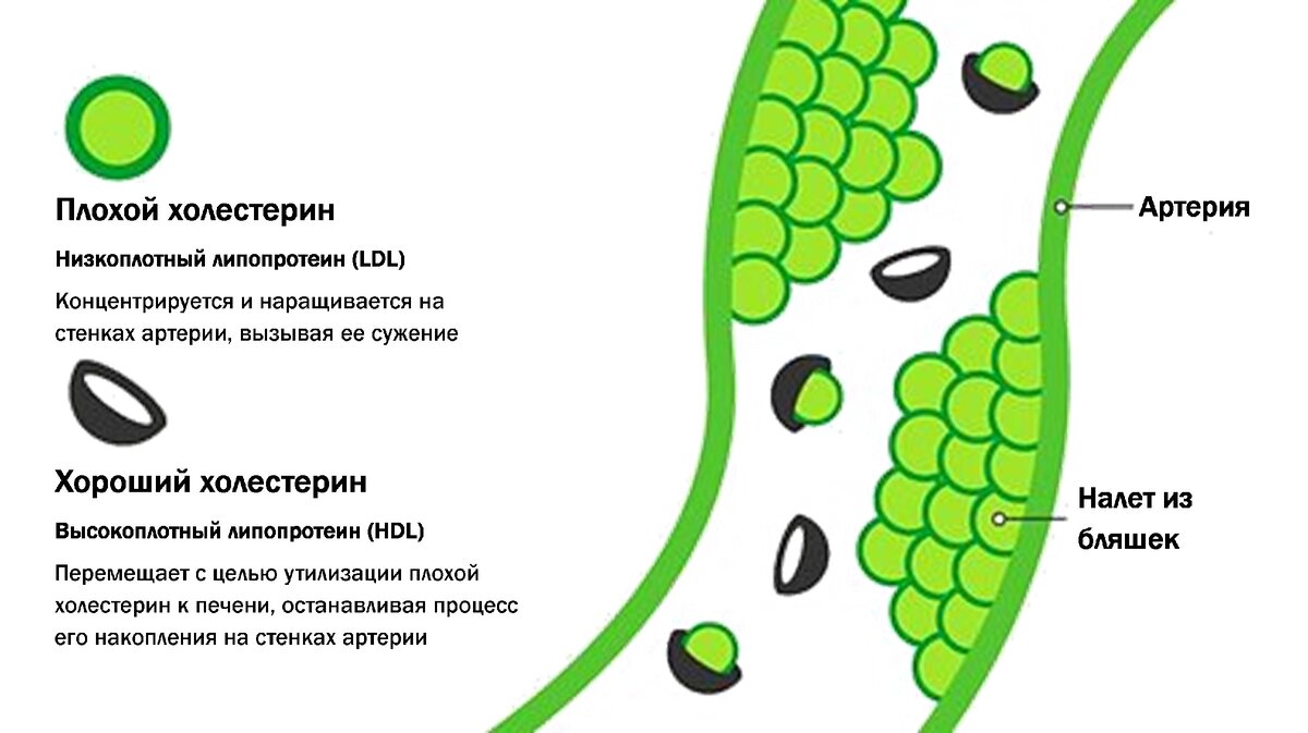 Повышенный холестерин - симптомы, причины и лечение в СПб