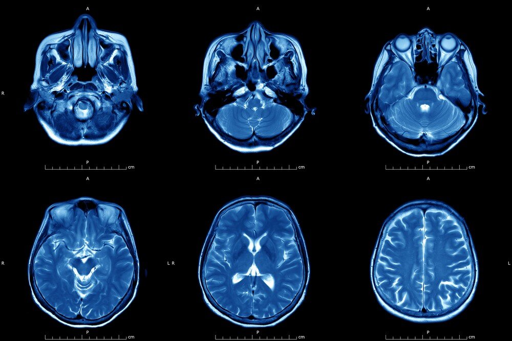 Снимок мозга