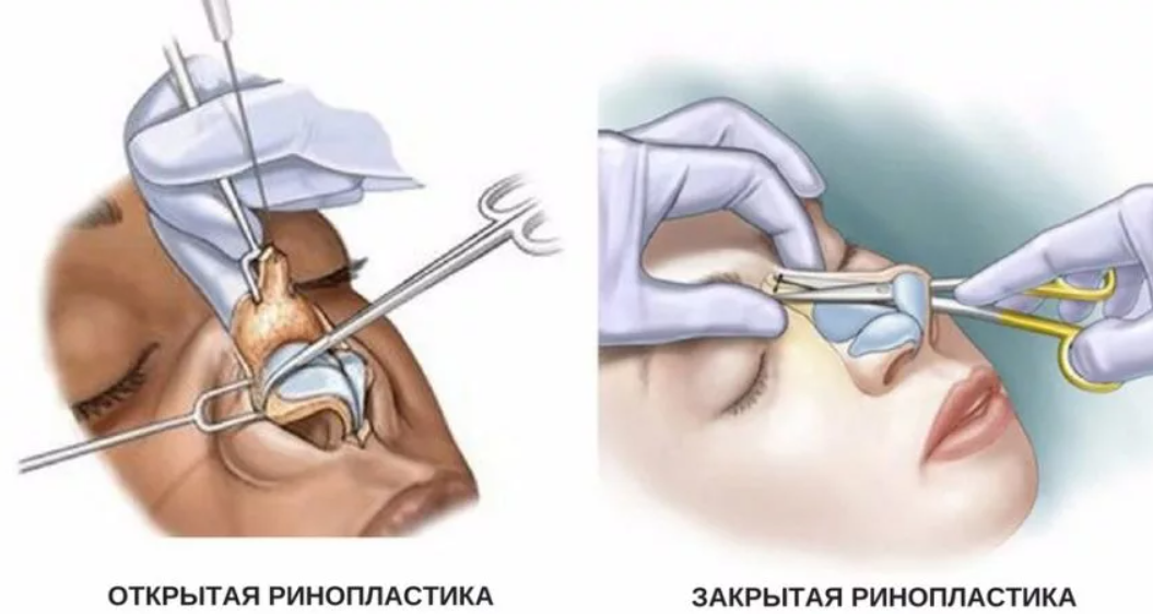 Хрящ носовой перегородки: Перфорация носовой перегородки: что это за проблема и 