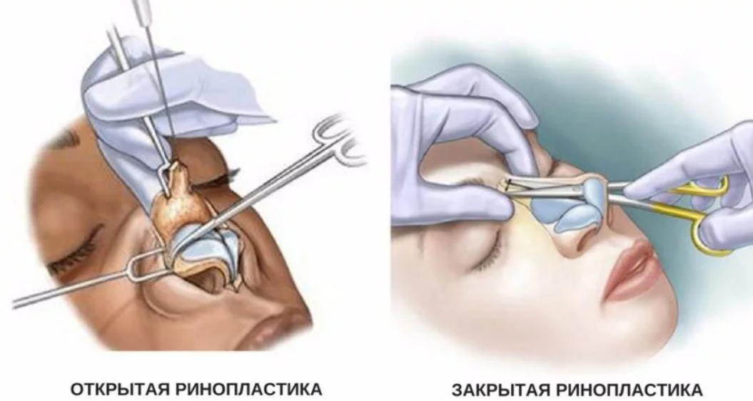 Как проходит открытые. Операция репозиция костей носа. Репозиция костей носа техника операции. Открытая ринопластика носа. Открытая и закрытая ринопластика.