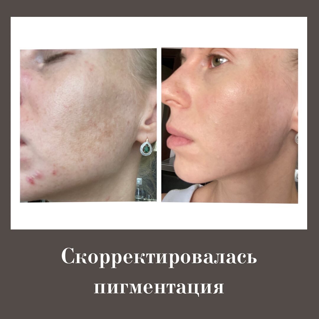 Мои «до» и «после» благодаря массажу лица и работе с телом 