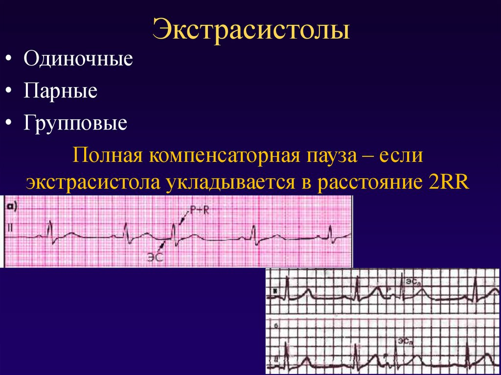 Эктопическая активность в виде одиночных экстрасистол. Одиночные предсердные экстрасистолы. Одиночная экстрасистолия. Одиночная предсердная экстрасистолия. Парные предсердные экстрасистолы