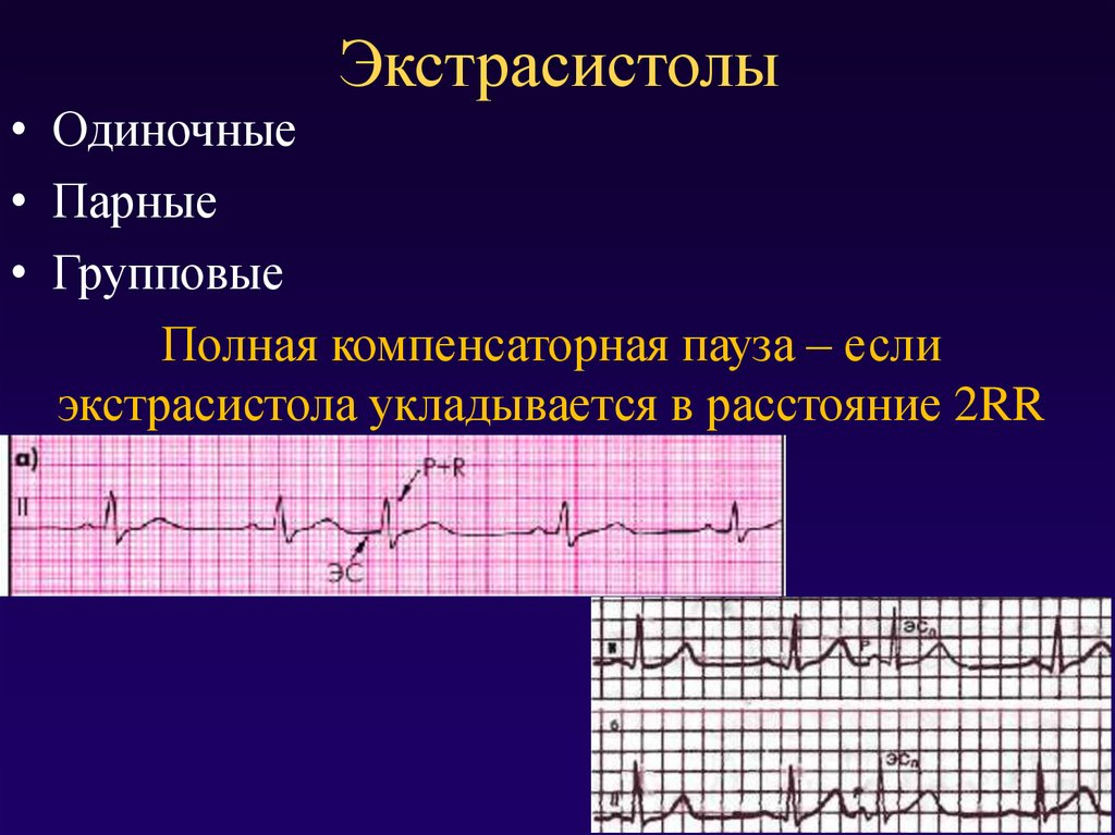 Наджелудочковая эктопическая активность в виде одиночных экстрасистол