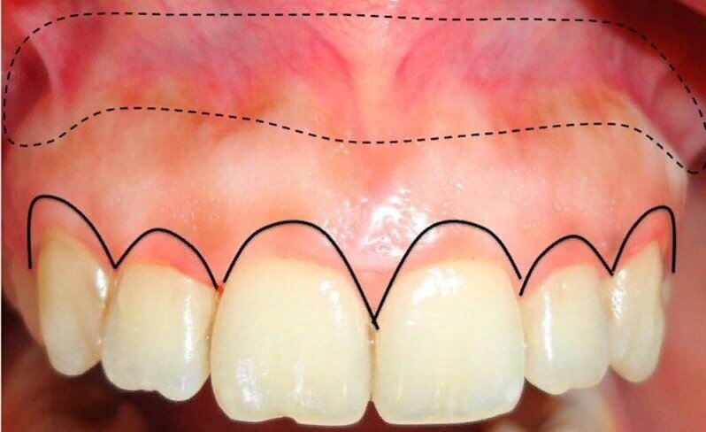 Варианты лечения десневой улыбки