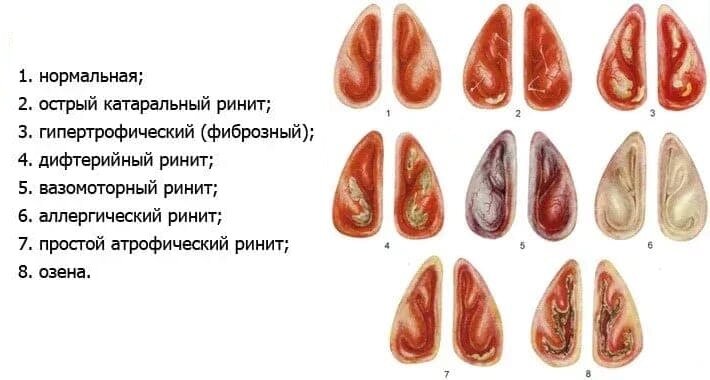 Озена это