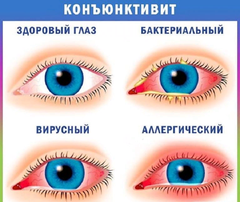 Схема лечения бактериального конъюнктивита у детей