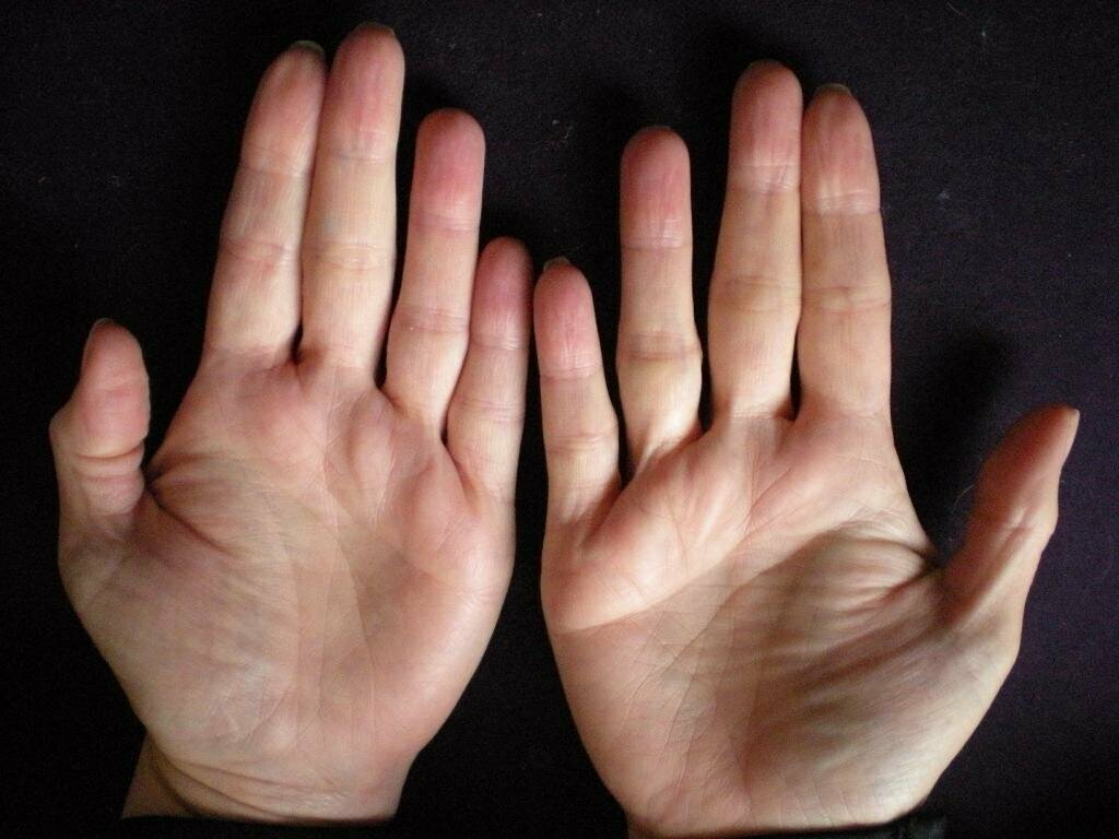 Линии отчаяния на указательном и среднем пальцах правой руки. Фото из открытого источника.