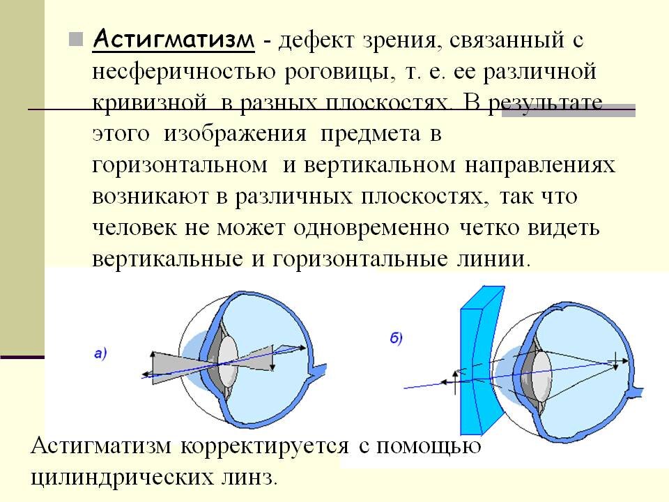 Недостатки зрения. Строение глаза астигматизм. Транспозиция астигматических линз. Искривление роговицы астигматизм. Нарушение зрения таблица астигматизм.