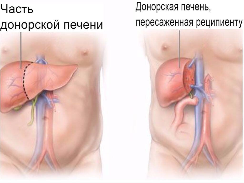 Всё о трансплантации печени. Вопросы и ответы от известного доктора |  МедикаТур. Медицинский туризм | Дзен