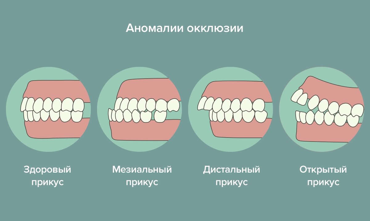 Виды зубного прикуса