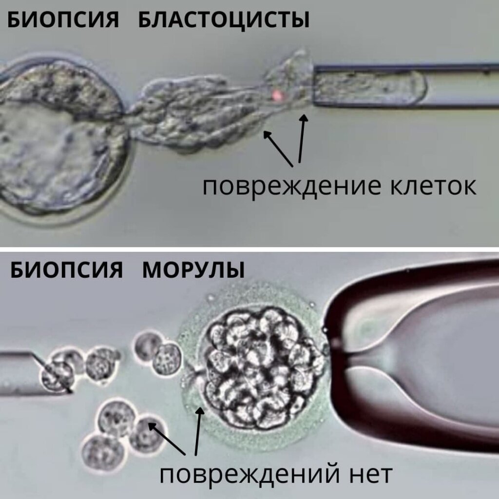 Биопсия морулы — единственный из существующих методов биопсии, который позволяет получить достаточное количество неповрежденных клеток с целой ДНК, а значит — максимально точный результат диагностики.