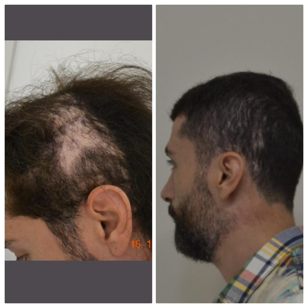 Dhi пересадка волос. Шрамы после пересадки волос. Трансплантация волос на шрам. Пересадка волос на голове.