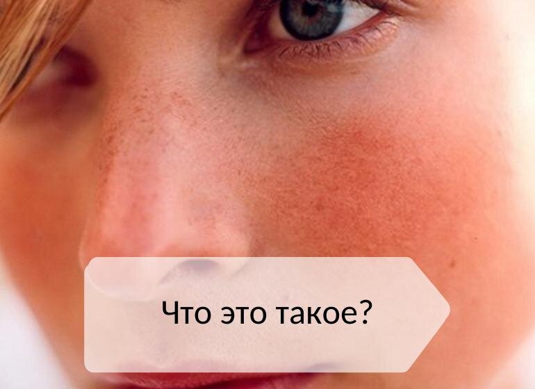 Купероз: как образуется