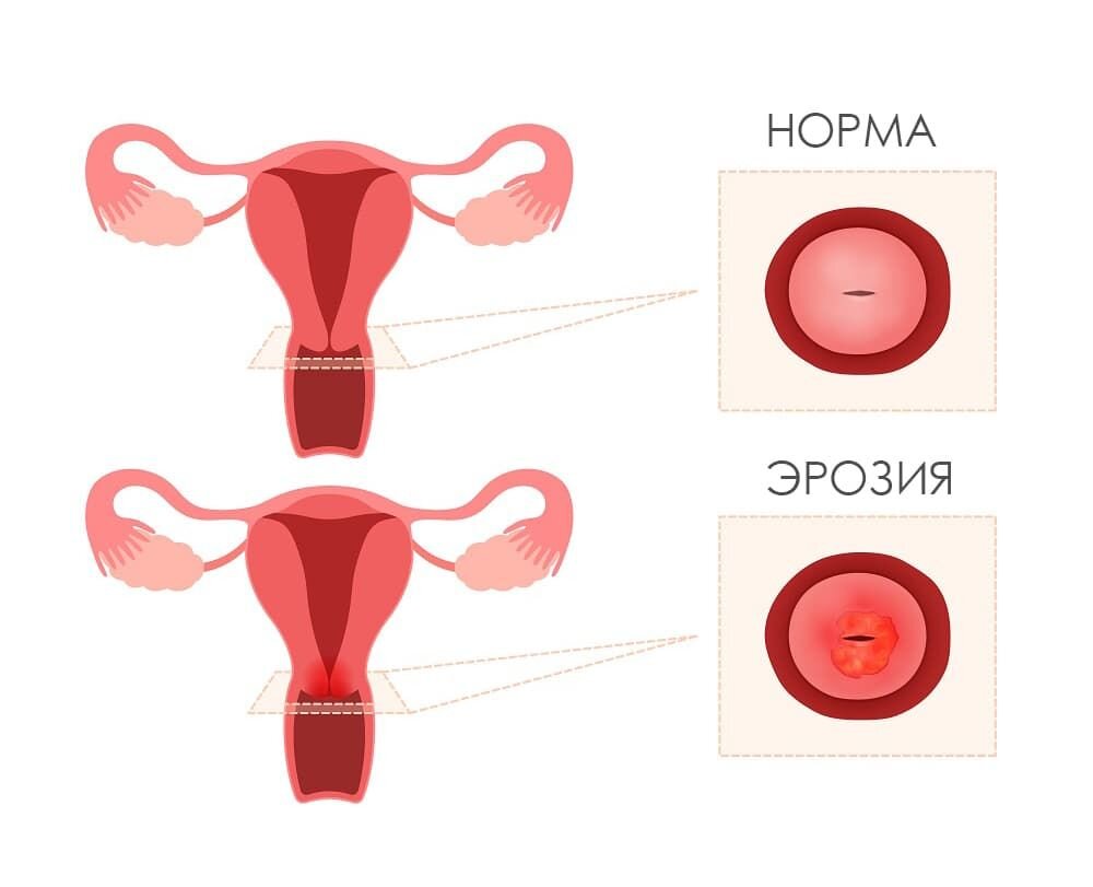 Эрозия шейки матки. Все о заболевании — Новости и Медиа | Олимп Клиник