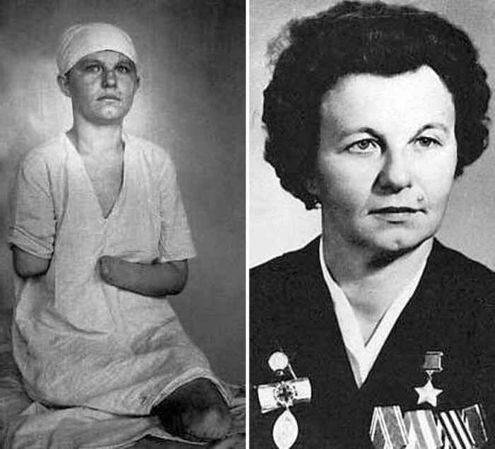 Туснолобова в 23 года осталась без рук и ног в результате тяжелого ранения и обморожения. 
