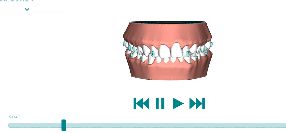 Прикус на седьмой капе в 3-d плане