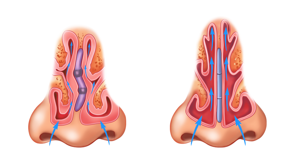 Что значит искривление носовой перегородки? 