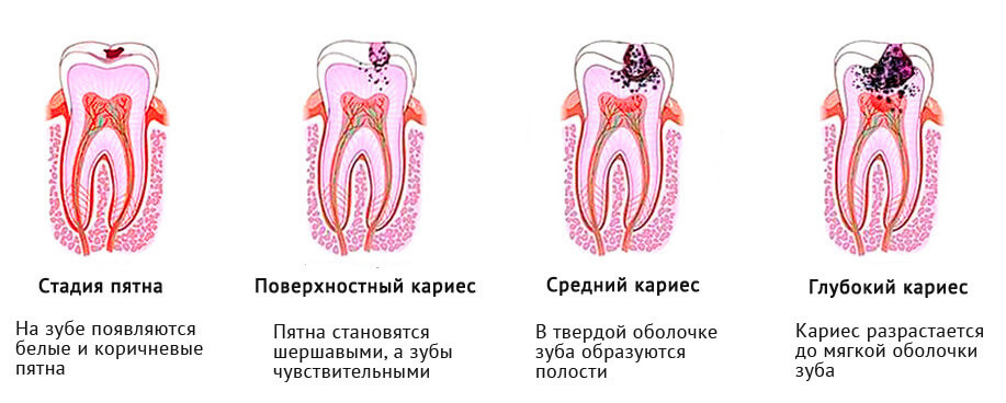 Стадии развития кариеса