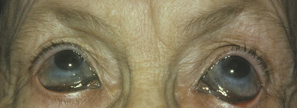 Аргирия глаз.