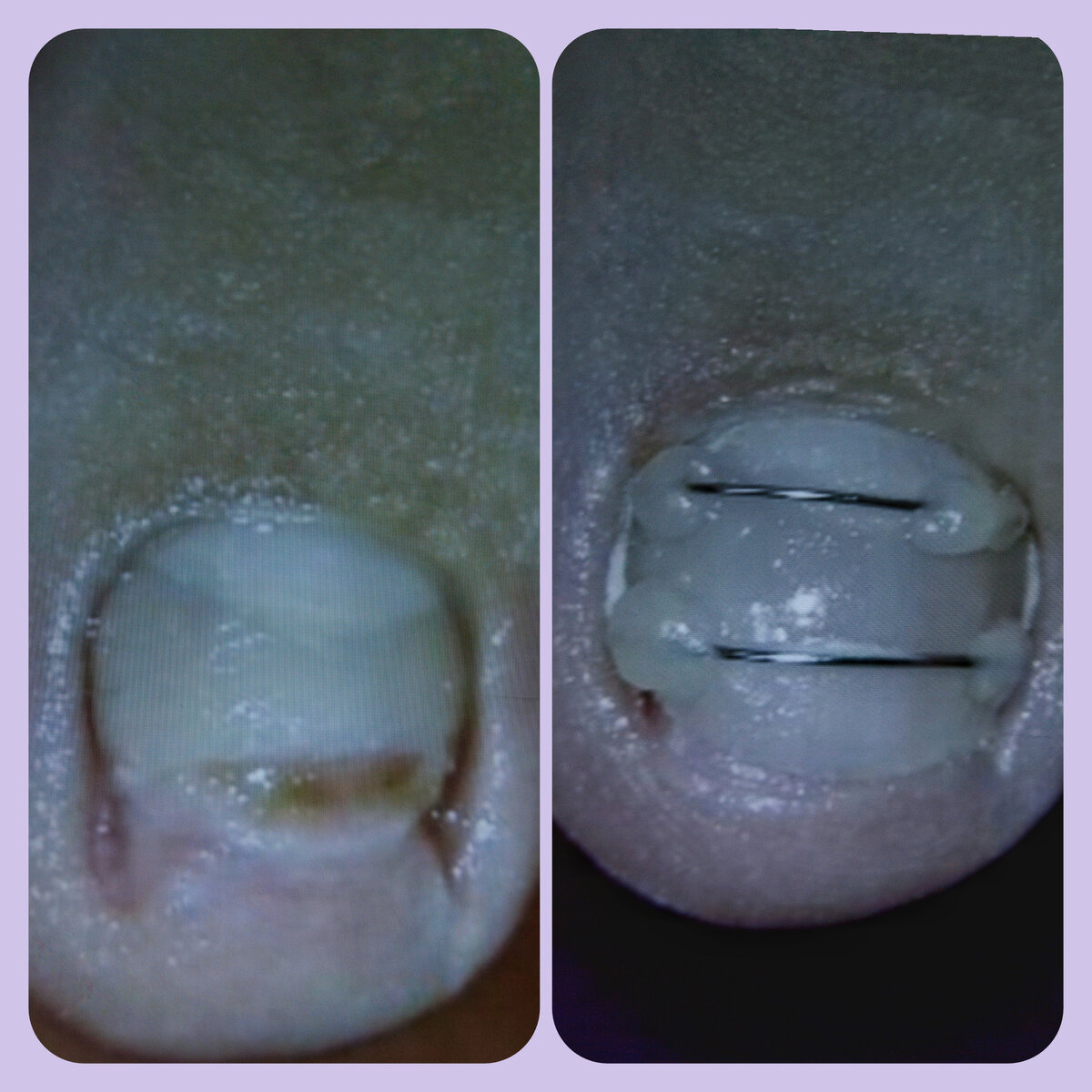 Коррекция вросшего ногтя с помощью скобы Фрезера: слева- до, справа - после установки скоб. Эта работа грамотного подолога помогла моей подруге избавиться от многолетней проблемы.