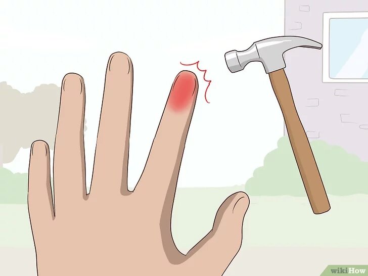 2.Определите, мог ли отек быть вызван травмой.  Травма является одной из самых распространенных причин отека. Различные жидкости, такие как кровь, скапливаются в травмированной области, что и приводит к ее опуханию. К поврежденному месту нужно сначала прикладывать холод (для сужения кровеносных сосудов), а затем — тепло [2]   (это способствует оттоку жидкости).Если ваш синяк или травма не проходят в течение двух недель, симптомы становятся все сильнее и проявляются чаще или вы наблюдаете признаки инфекции на коже, немедленно обратитесь к врачу.
