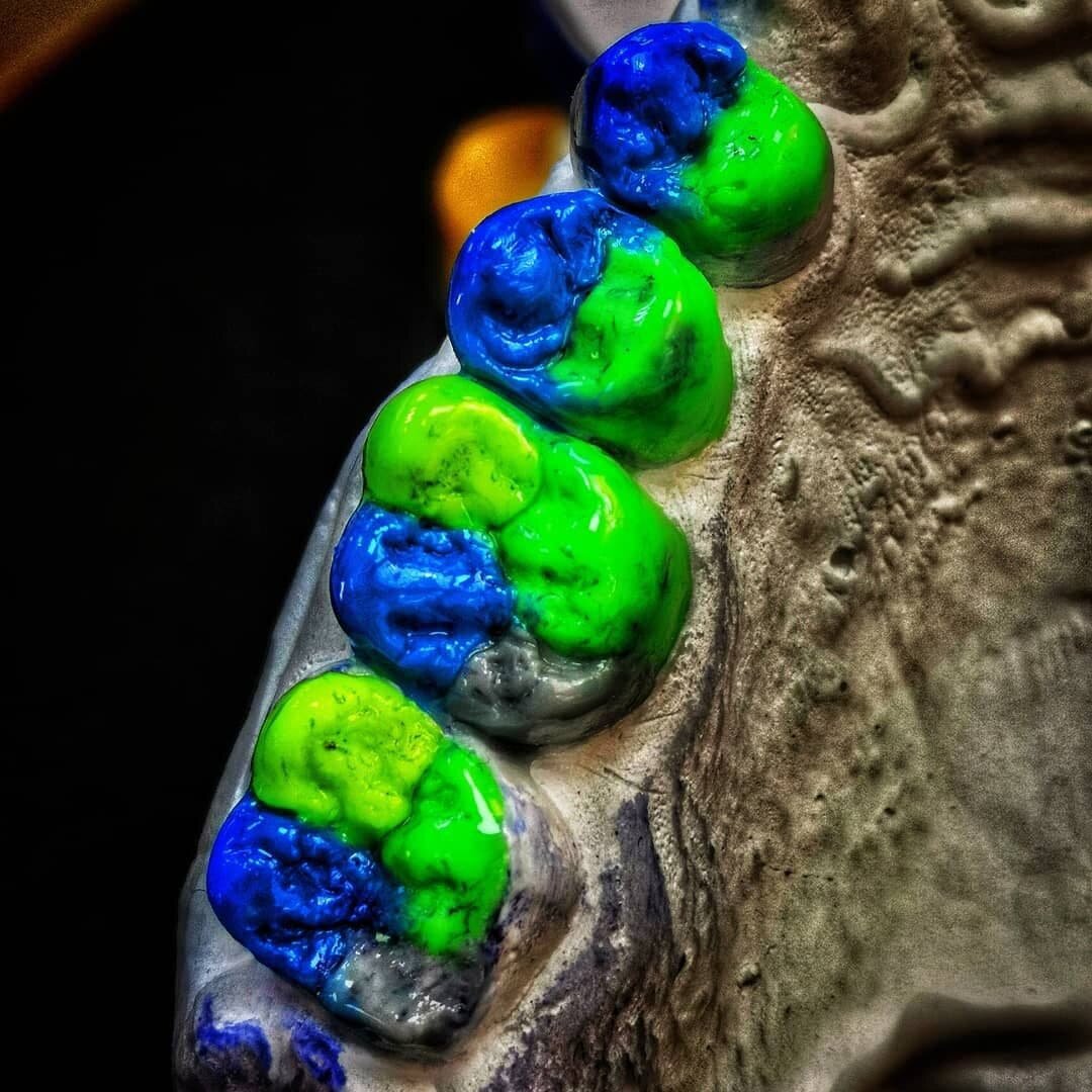 Восковое моделирование зубов по окклюзионному компасу