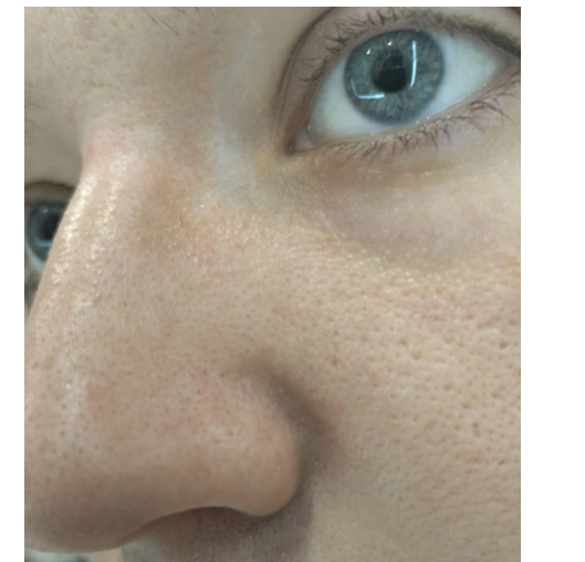 Фото до устранения черных точек.