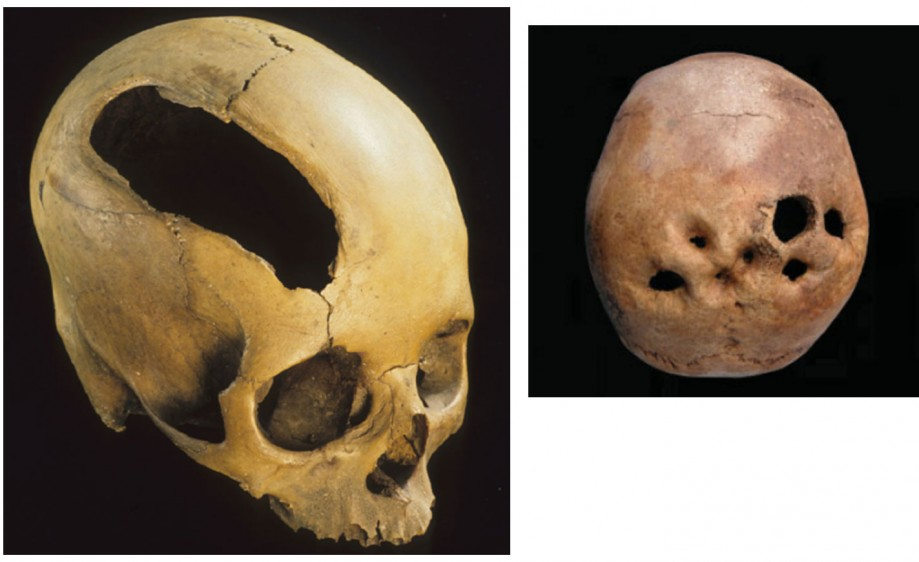 трепанированный череп. С сайта antropogenez.ru