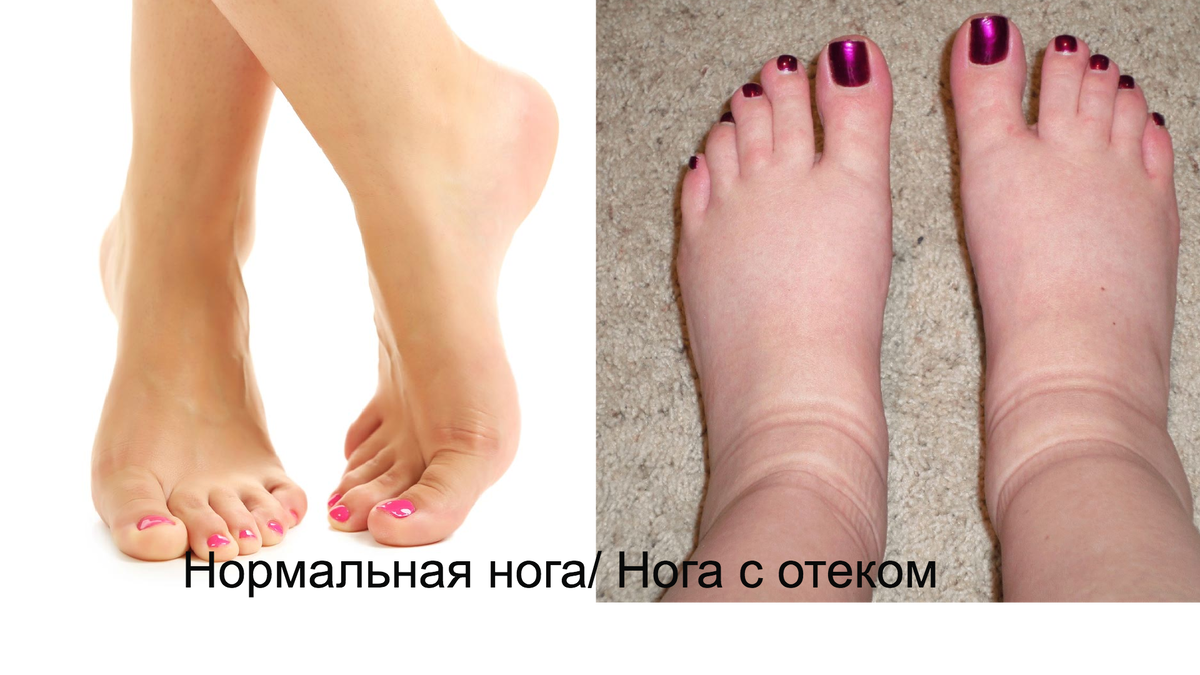 Упражнения для уменьшения отечности ног
