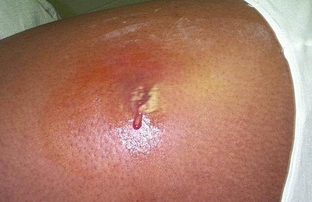 Бугорки, шишки и уплотнения на внутренней стороне бедра