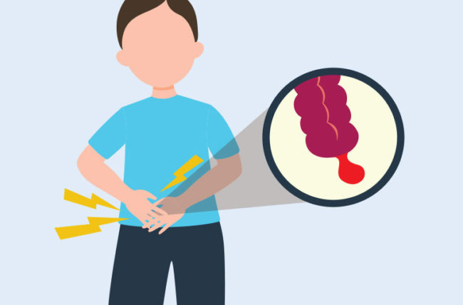Как выглядит аппендикс у человека Pin on Appendectomy
