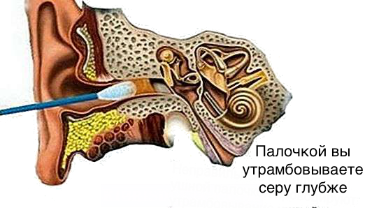 Почему нельзя чистить уши ватными палочками. Как достать пробку из уха ватной палочкой. Нельзя чистить уши ватными палочками. Чистка ушей ватными палочками. Почему нельзя чистить уши ватными палочками.
